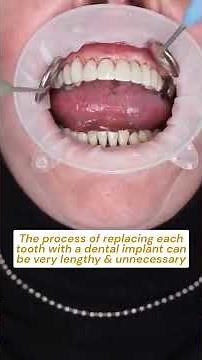 Secure. Natural. Confident. 🦷 Implant-supported bridges explained. #Shorts #shorts
