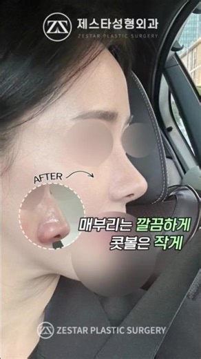 A beautiful nose that looks good even without implants #shorts #rhinoplasty