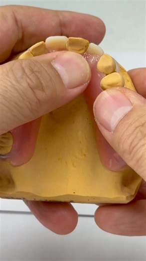 Tooth color clasps from Acrylic partial! Fairview Dental in Idaho | Luke Kahng
