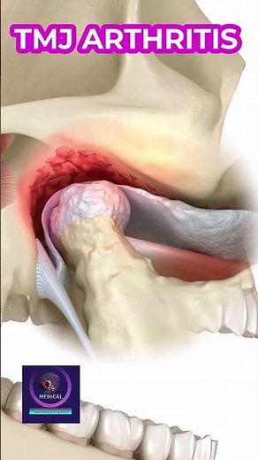 TMJ Arthritis: Causes, Symptoms, and Effective Treatment Options