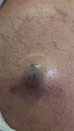 Sebaceous Cyst Swelling