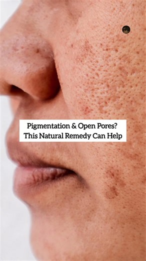 Pigmentation and open pores? Try this simple brightening face pack.