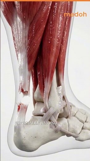Understanding the Achilles Tendon Anatomy & Injury\n\nThe Achilles tendon is the strongest tendon i...