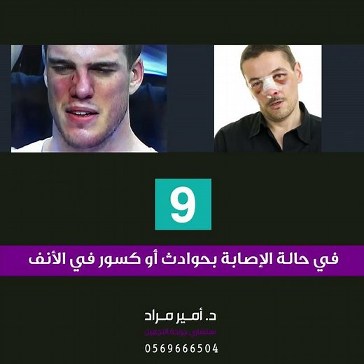 عشرة أسباب تدفعك لإجراء عملية تجميل الأنف