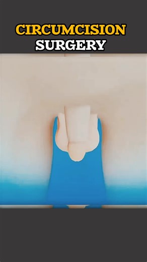 Understanding Circumcision Surgery and Healing Process