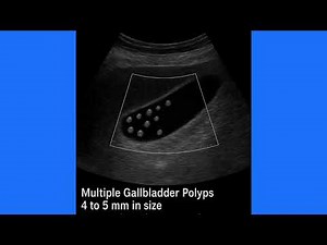 Gallbladder Polyps on Ultrasound & Color Doppler: Imaging, Types & Prognosis Explained