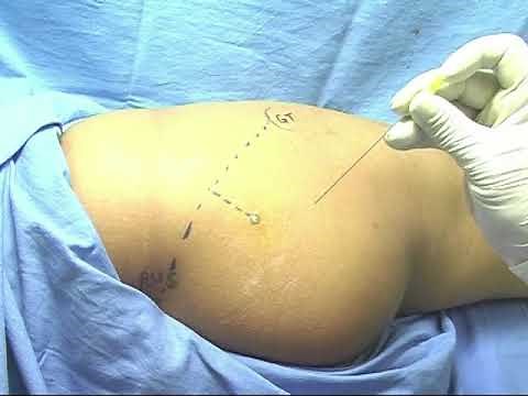 Sciatic Nerve Block (Post Approach):Dr Devendra K Gupta