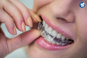 Cheap Invisalign Abroad | Explore Invisalign Tourism with DentaVacation