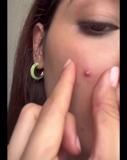 Satisfying Pimple Popping ASMR | Brufoli, Cravos, Blackhead | Zit Popping