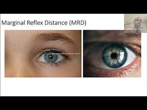 Ptosis Examination Clinical Skills in Ophthalmology