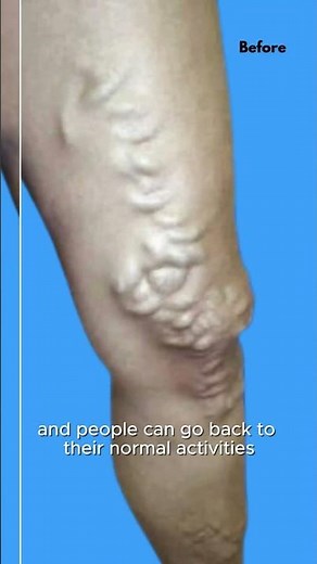 Varicose Veins - Before and After