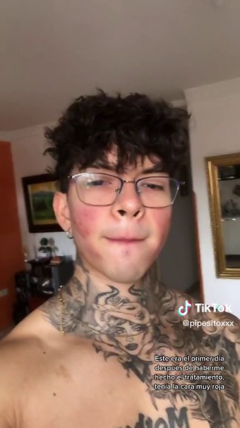 #fyp #greenscreen #dermapen | dermapen