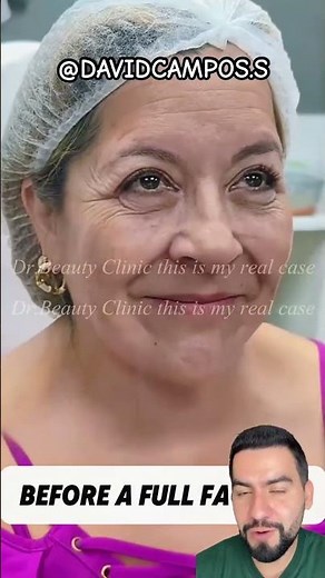 FACIAL HARMONIZATION