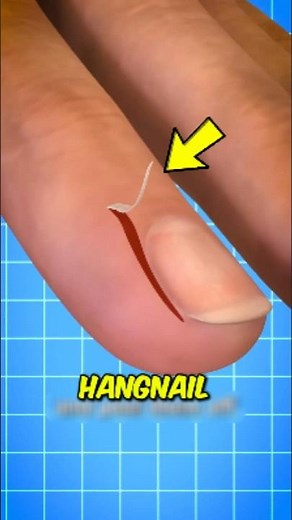 NEVER Rip Off a Hangnail! 😱 Here’s What Can Happen #Hangnail #HealthTips