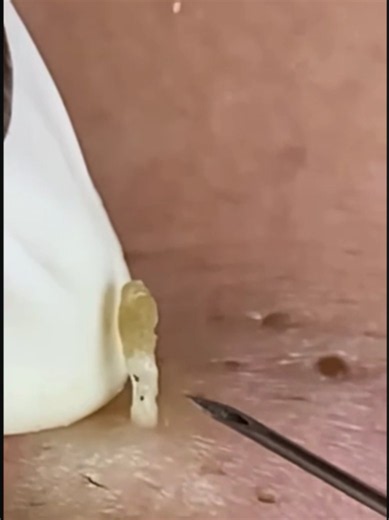Minha mente ficou 100% leve depois dessa limpeza. Dá um zoom! 🔍💥 ​#satisfatorio ​#cravoseespinhas ​#limpezadepele ​#remocaodecravos ​#skincarebr