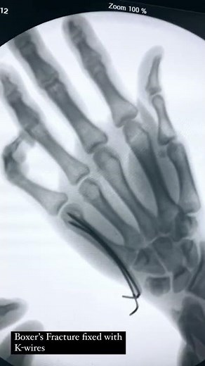 Boxer’s Fracture Fixation with K-wires by AO Trauma Principles.