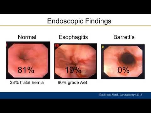 Practical Approach to Management of Extra-esophageal GERD