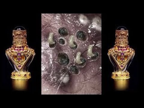 Best Blackhead Removal #002 - Facial Acne Treatment - Gà Spa