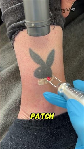 Why Is This Gel So Important for Tattoo Removal? 😱