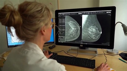 New AI Model Uses Mammograms to Predict Breast Cancer Risk