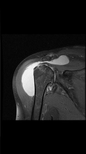 Subacromial Bursa Explained in 30 Seconds | #shoulderpain #anatomy #meded #physiotherapy #shoulder