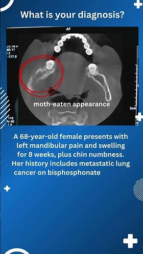 Moth-eaten mandible jn acute osteomyelitis #oralpathology #dentist #osteomyelitis #radiography