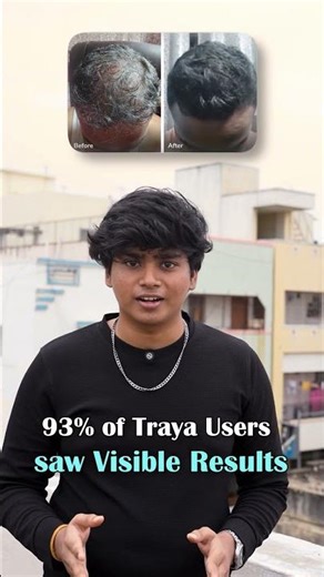 Best way for dealing with hair loss in 2025 | #shorts