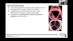 Carcinoid Syndrome: Relationship to NETs, Clinical Overview, and Treatment Principles