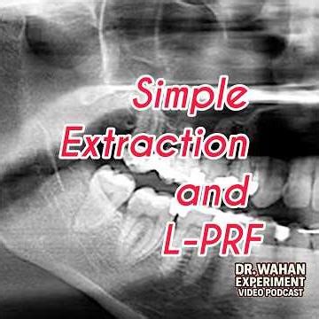 Simple Molar Extraction and L-PRF