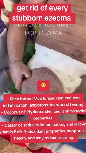 Effective Remedies to Get Rid of Stubborn Eczema