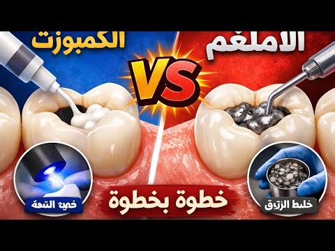 Composite vs Amalgam Filling 🦷 Step by Step Procedure | Which is Better?حشوة الكمبوزت vs الأملغم🦷كيف