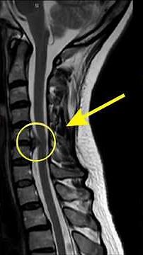 Stop stretching your neck #cervicaldiscbulge