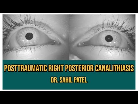 Post-traumatic Right Posterior Canalithiasis