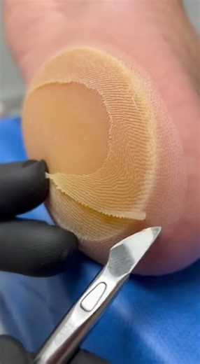 Clinical Heel Callus Treatment Relaxing Scalpel Sounds #asmr #satisfying #podiatry #peliculas #ai