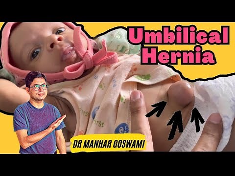 Umbilical Hernia in Newborn | How to manage umbilical hernia in baby | Doctor Ki Baat