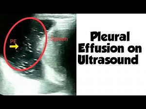 Pleural Effusion | Chest Ultrasound | Plankton Sign