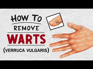 Remove Warts at Home – Simple Steps That Work!
