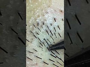毛抜き〜出血ありなので閲覧注意〜