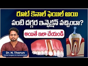 What Is an Apicoectomy || Step by Step Apicoectomy Procedure || Eledent Dental Hospitals