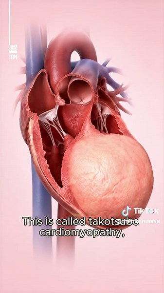 Happy Heart Syndrome: When Extreme Joy Mimics a Heart Attack