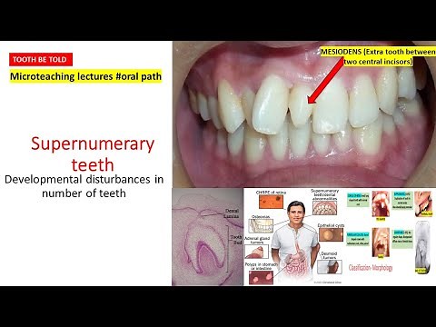 Supernumerary teeth |Types of supernumerary teeth | Causes | Gardner's syndrome, Treatmen