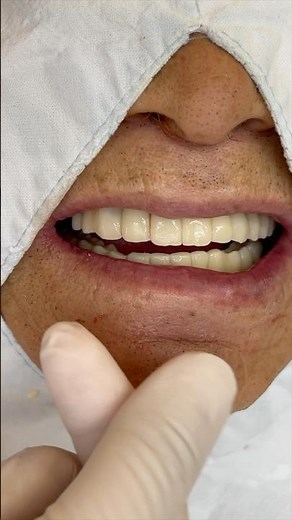 ✈️👄full mouth implant temporary teeth👍🦷 #dentist #dental #dentistry