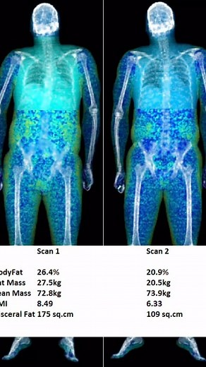 Looking to get a detailed analysis of your body composition? DEXA scans are the gold standard! This non-invasive test provides accurate and precise measurements of your bone, fat, and muscle mass, helping you to better understand your body composition and set achievable fitness goals. Whether you’re an athlete looking to optimize your performance or just trying to improve your overall health, DEXA scans are an essential tool for anyone serious about their fitness journey. So why wait? Book your 