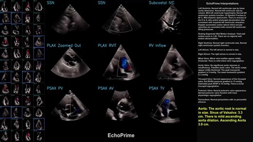 Echocardiography is one of the most complex medical image sets to analyze, with multiple views   cardiac motion. A new Nature Magazine paper shows how A.I. can do that and provide accurate… | Eric Topol, MD | 15 comments