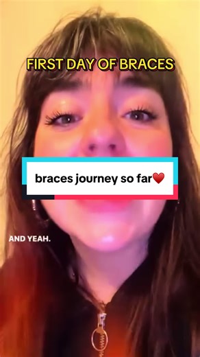 what a transformation 😮🫣 getting braces has been the most incredible thing I’ve done for myself. The level of confidence it has given me has been truly unmatched. If I feel this good with a mouth full of metal I can’t wait to experience life afterwards with a big smile 😃 for people that have grown up with naturally nice teeth it probably sounds dramatic but this has been absolutely life changing already 🥹🖤 #braces #bracesjourney #braceface #metalmouth #bracescheck 🖤♥️