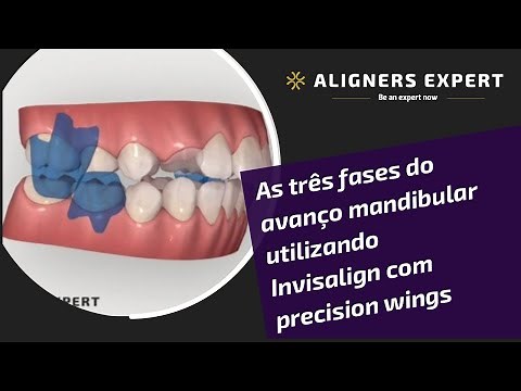 As três fases do avanço mandibular utilizando Invisalign com precision wings
