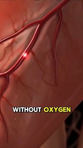 What Really Happens During a Heart Attack (3D Animation) #heart #HeartHealth #heartattack #HeartAttackAwareness #heartattacksurvivor #heartattackchallenge #heartdisease #oxygen #emergency #heartdoctor #heartdiseaseawareness #medical3danimation #3dmedicalanimation | Medcare777