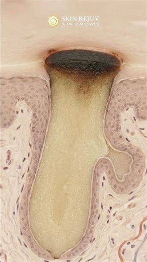 Blackheads Explained: Causes, Myths & Best Treatment for Clear Skin