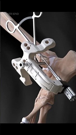 Fibula Nail Surgery Explained in 3D Animation