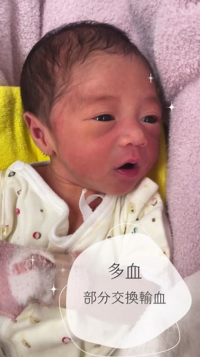 新生児の多血症とNICUの経験